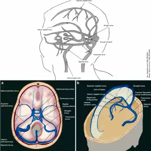 Venous Sinuses